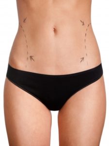 Tummy Tuck Surgery korea