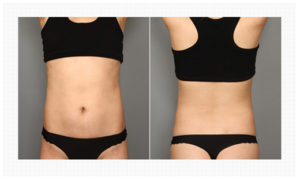 Thigh Liposuction korea